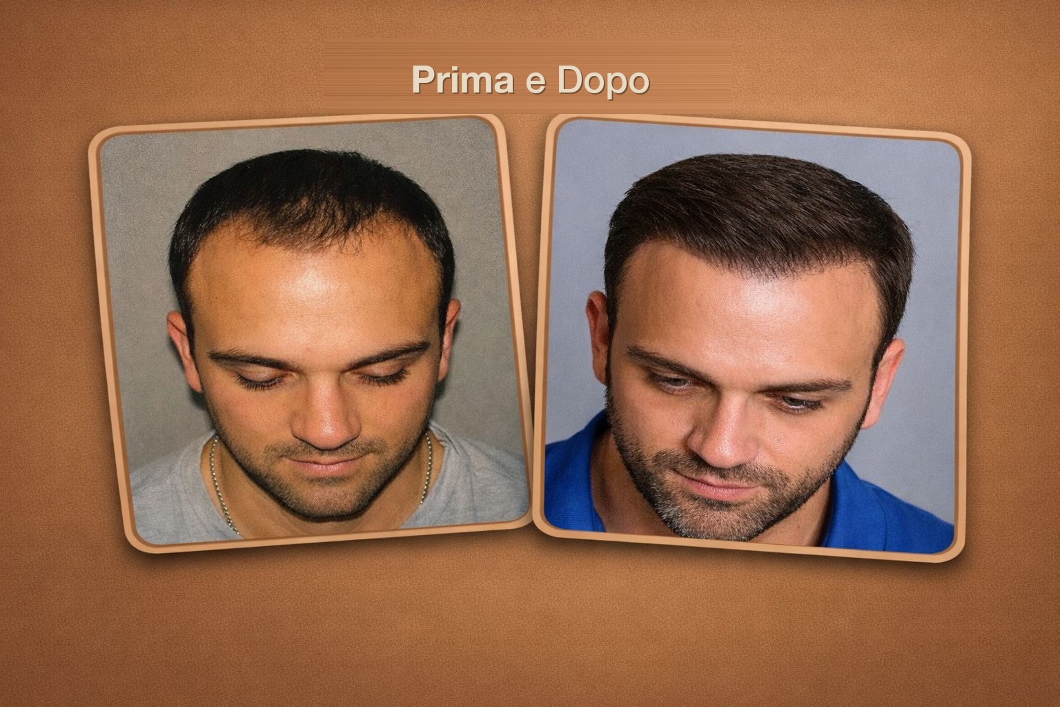 Risultato reale trapianto capelli Global Health Hair 3