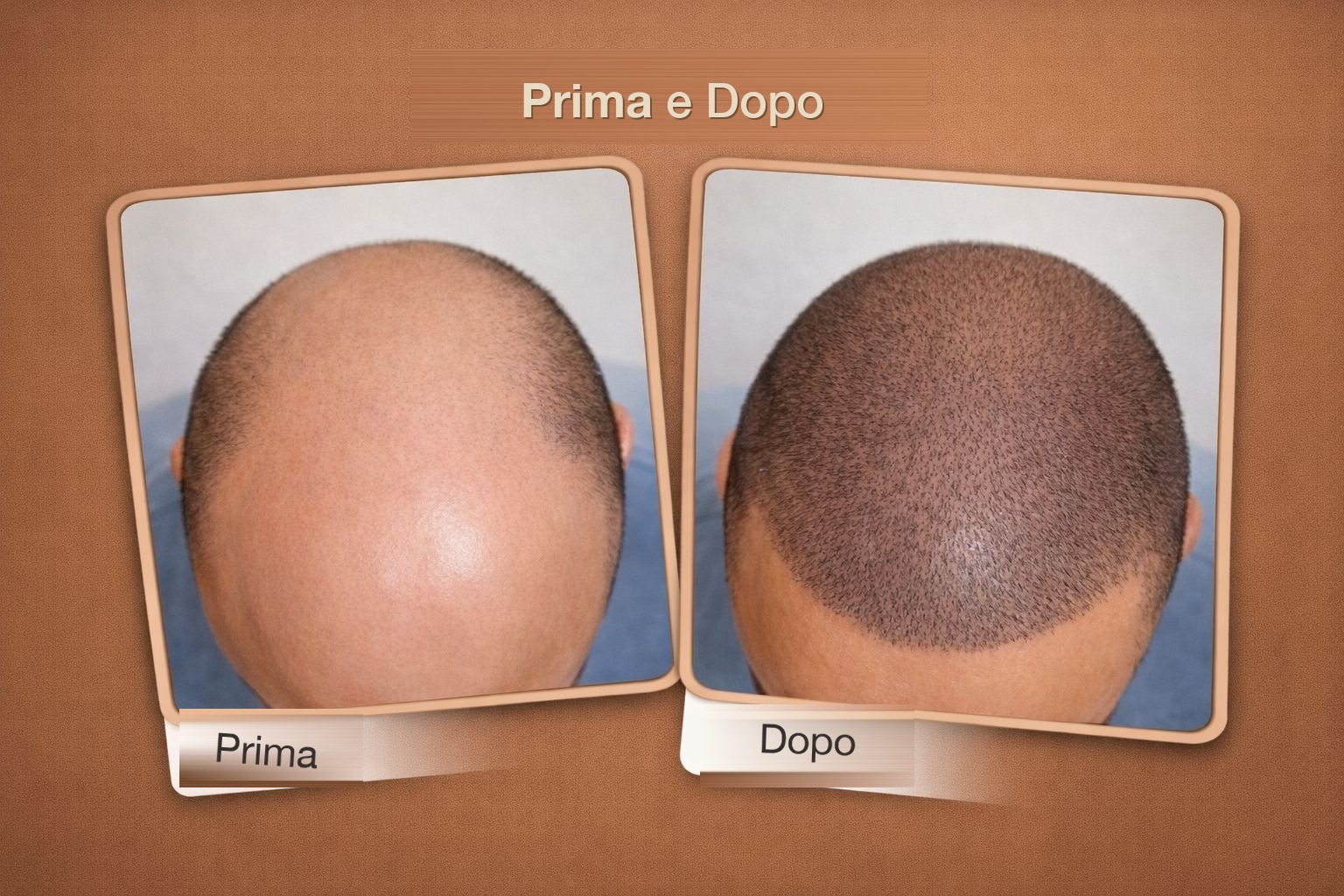Risultato reale trapianto capelli Global Health Hair 6