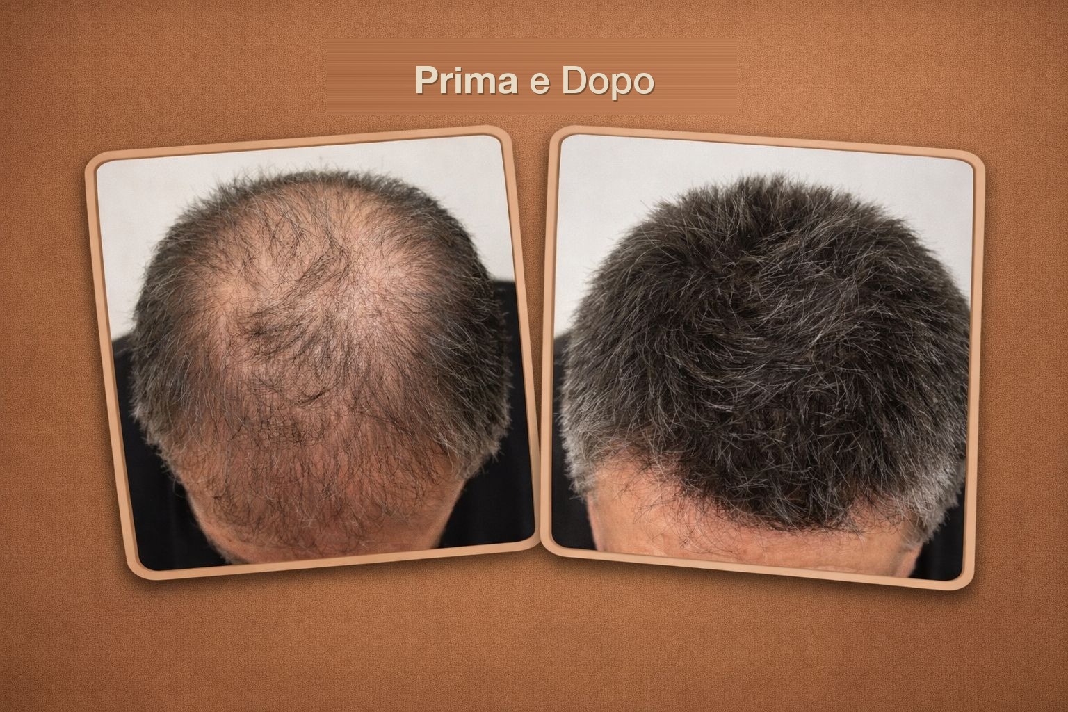 Risultato reale trapianto capelli Global Health Hair 8